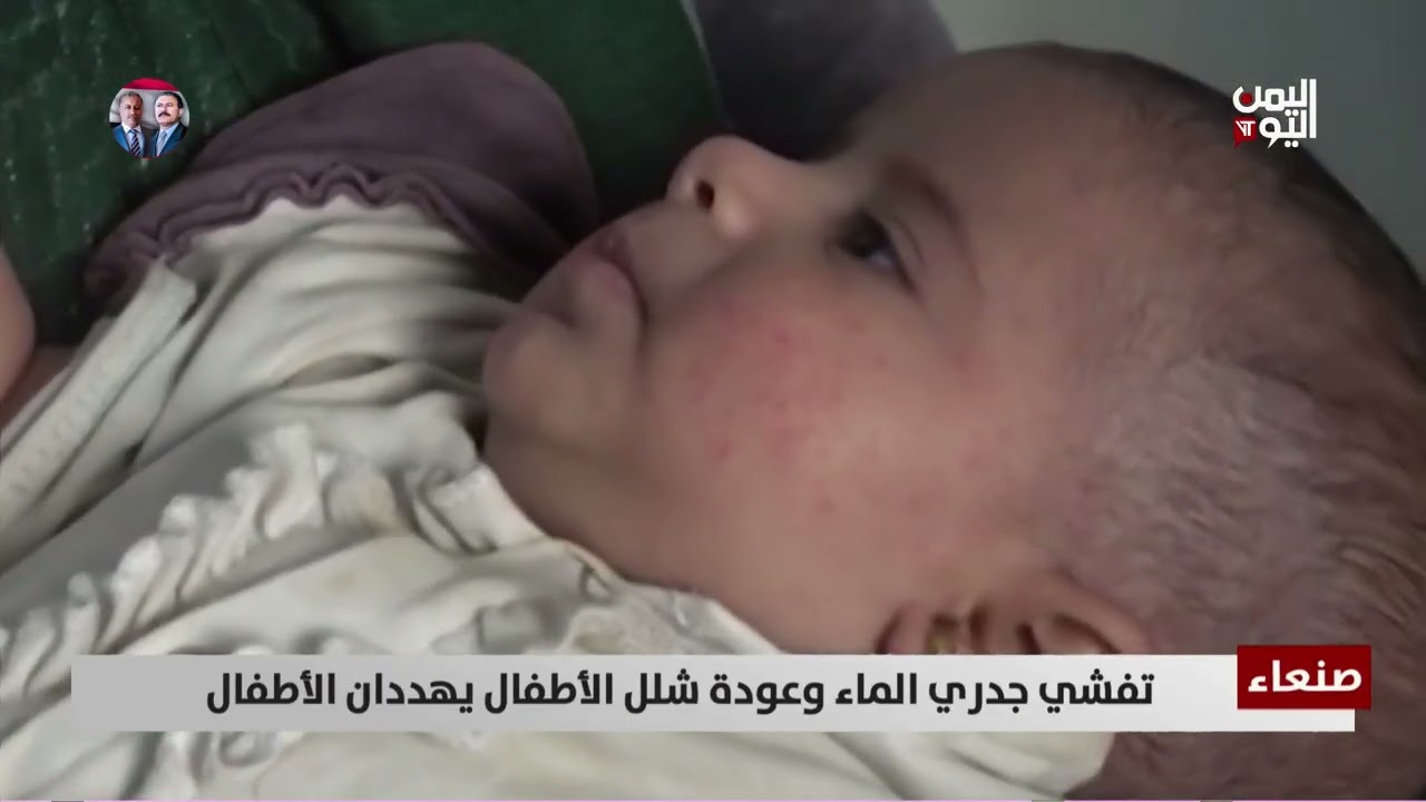 صنعاء | تفشي جدري الماء وعودة شلل الأطفال يهددان الأطفال - تقرير: عبدالله الوادعي