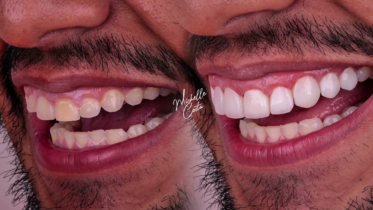 Antes e Depois de Facetas em Resina Composta | Transformação de Sorriso Natural em Madureira - RJ