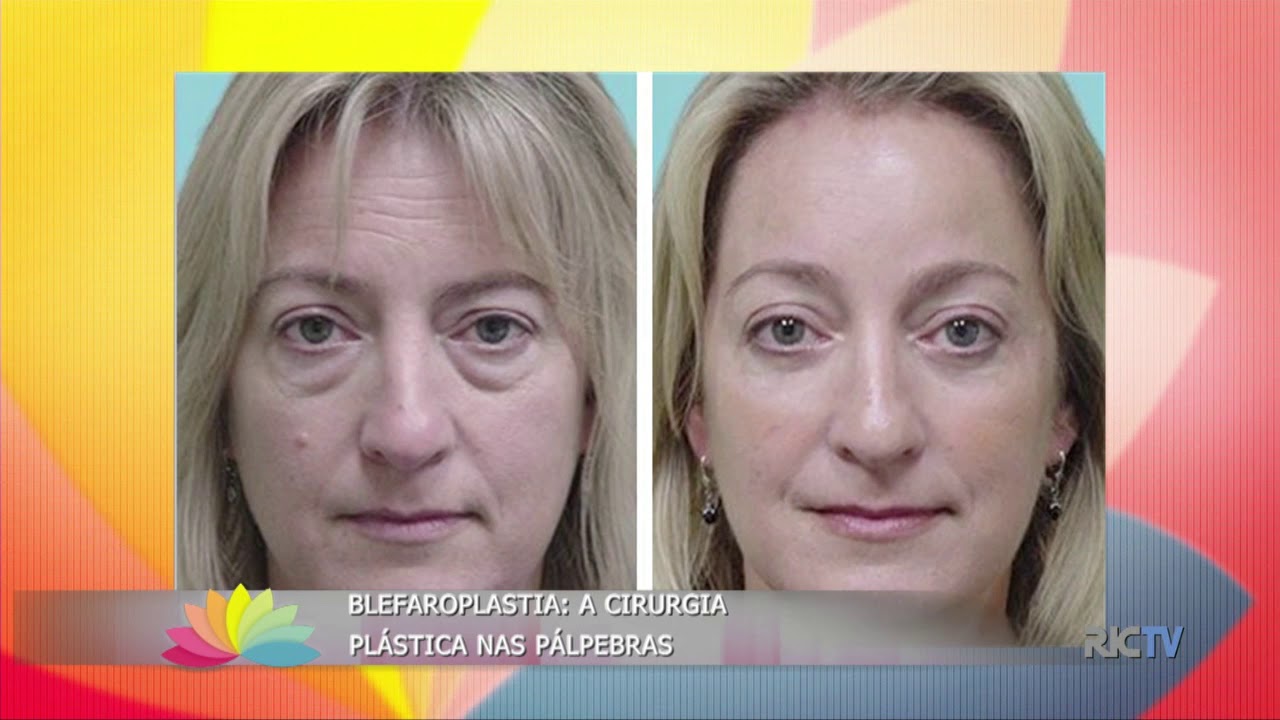 Cirurgia nas pálpebras rejuvenesce e levanta o olhar