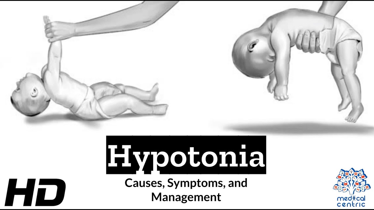 Hypotonia Explained: What You Need to Know