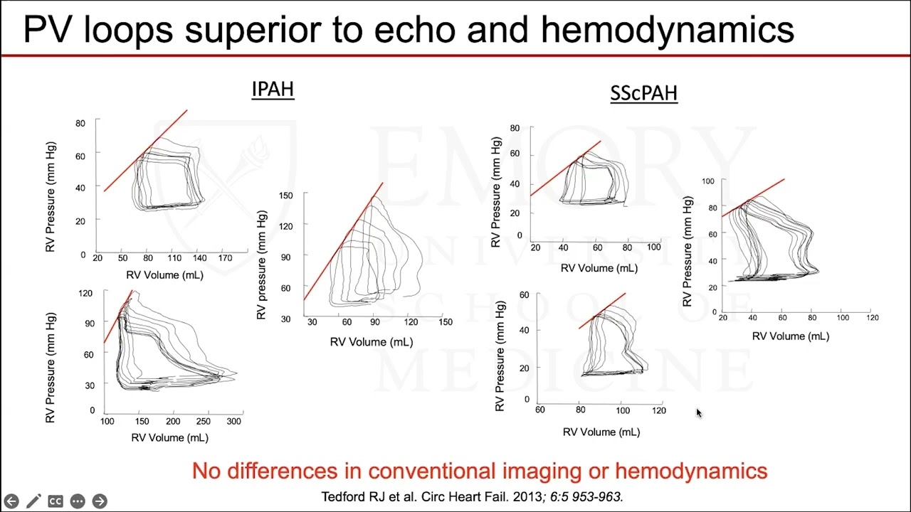 Right Ventricular Mechanics in Health and Disease