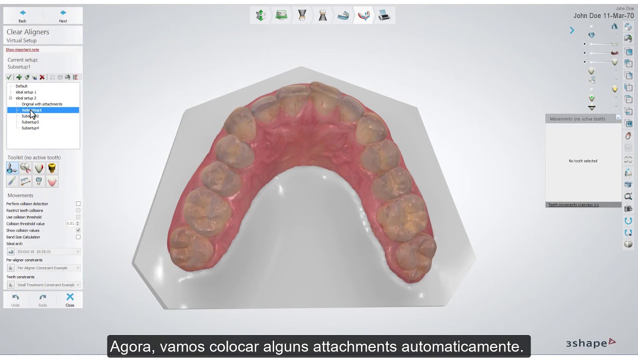 3Shape Clear Aligner Studio - Automatic Attachment Placement BR PT