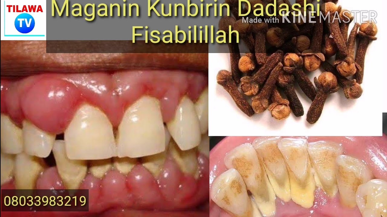 Maganin cowan dadashi Na hakori fisabilillah.