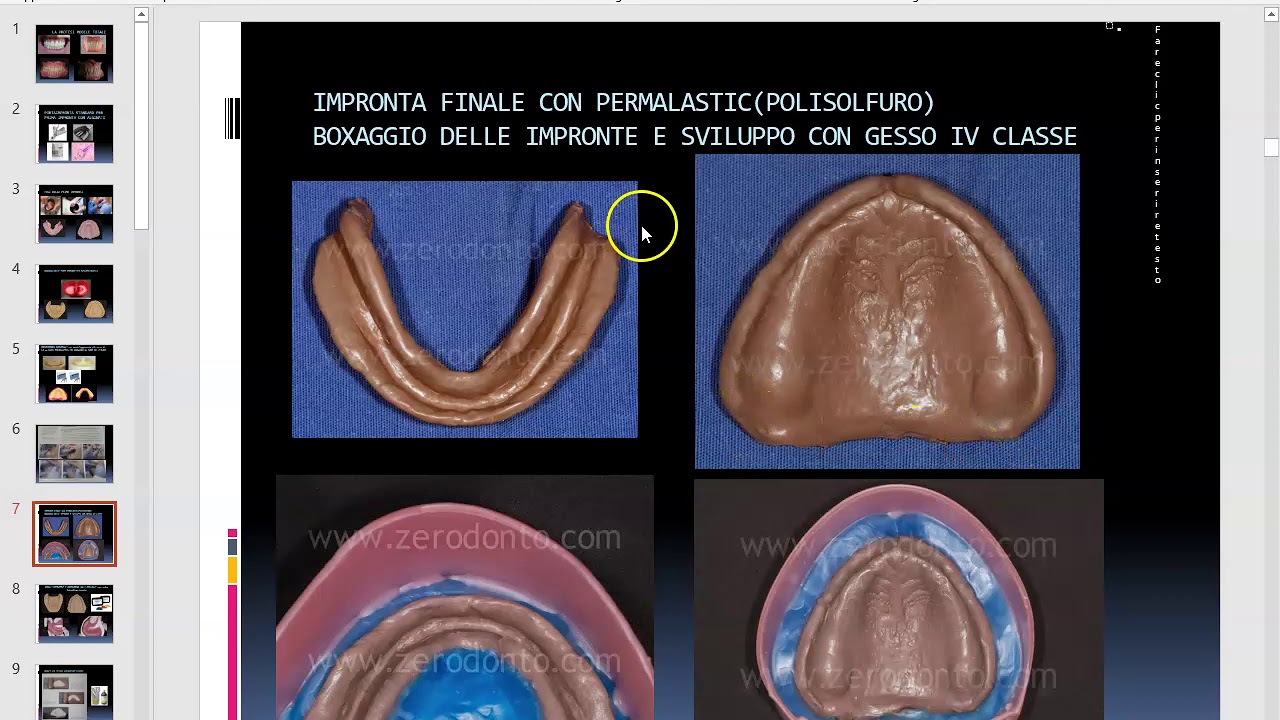 Protesi mobile totale 1^ fase