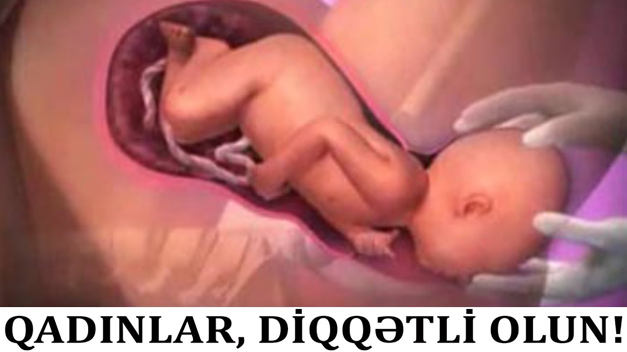 Keysəriyyə əməliyyatı olmuş qadın doğa bilərmi?
