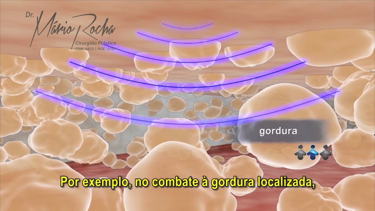 Ultrassom para tratamento de Celulite, Gordura Localizada e Flacidez