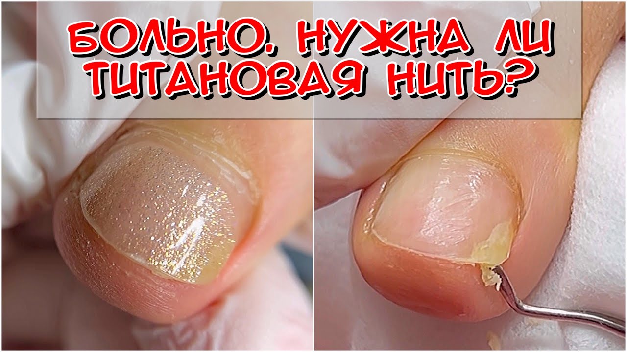 Нужна титановая нить? / Скрученный ноготь / Размягчающее средство для ногтевых пластин от DOMIX
