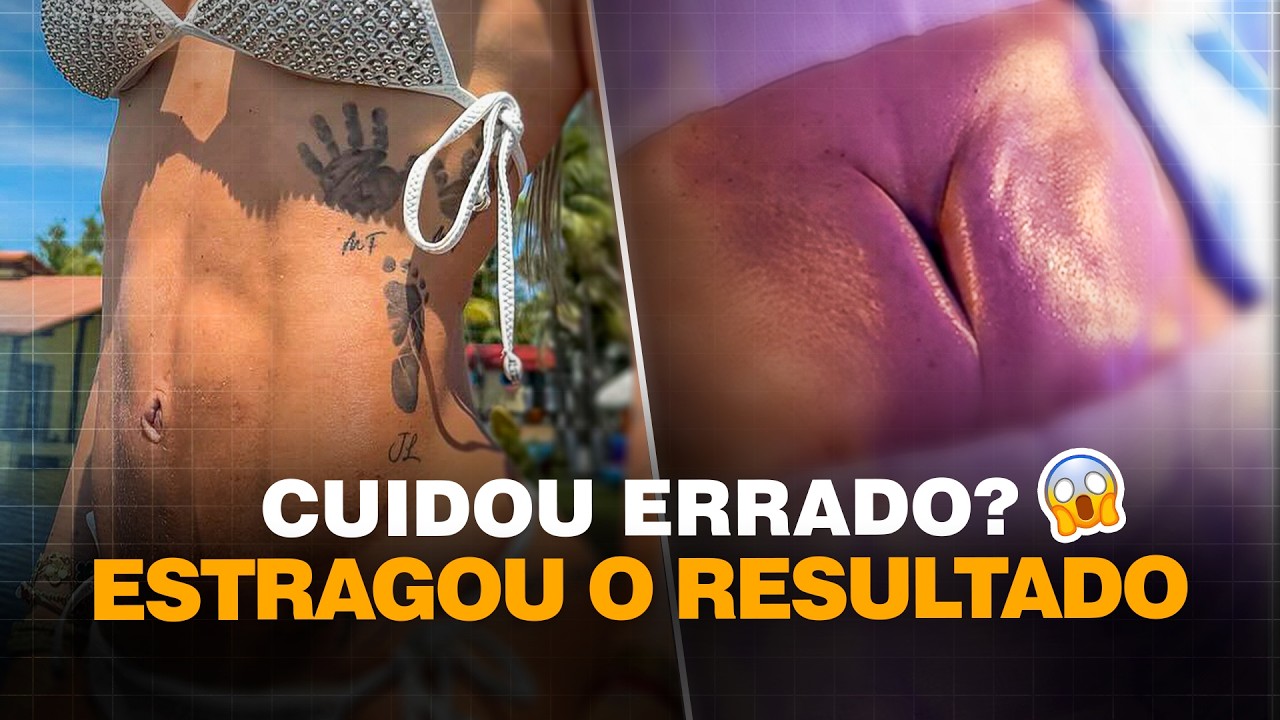 Como Cuidar do Umbigo Após Abdominoplastia (Sem Estragar o Resultado!) Cirurgia Plástica | Dr. Ícaro