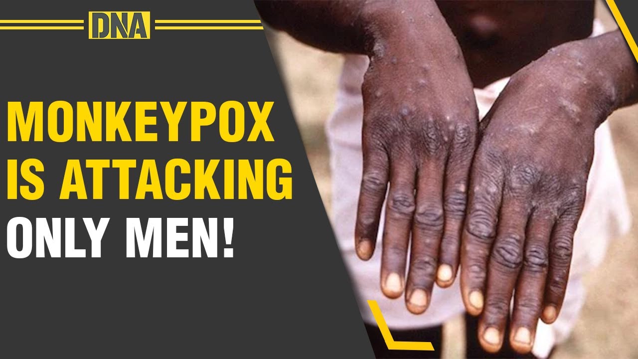 Monkeypox cases rose to over 6,000, almost all patients are male: WHO