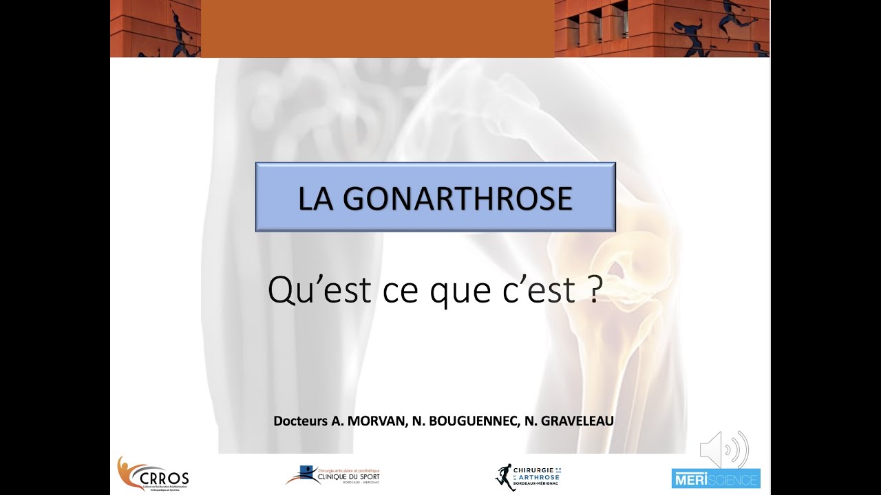 La gonarthrose (arthrose du genou) : définition et explications