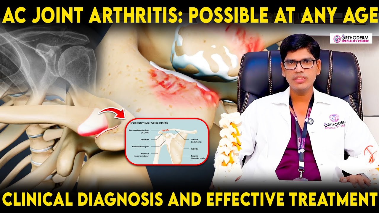 AC Joint Arthritis: Possible at Any Age|Clinical Diagnosis & Effective Treatment | Orthoderm Centre