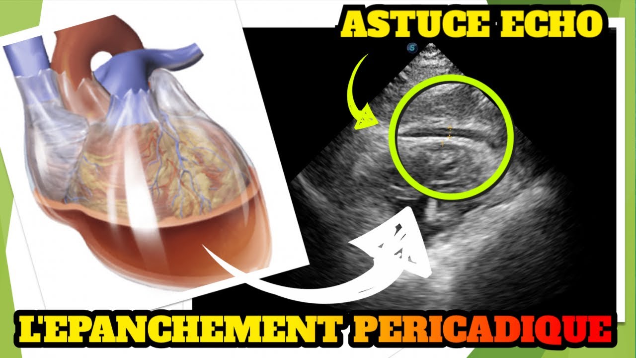 Epanchement pericardique en echographie: pensez à la coupe sous xyphoidienne!