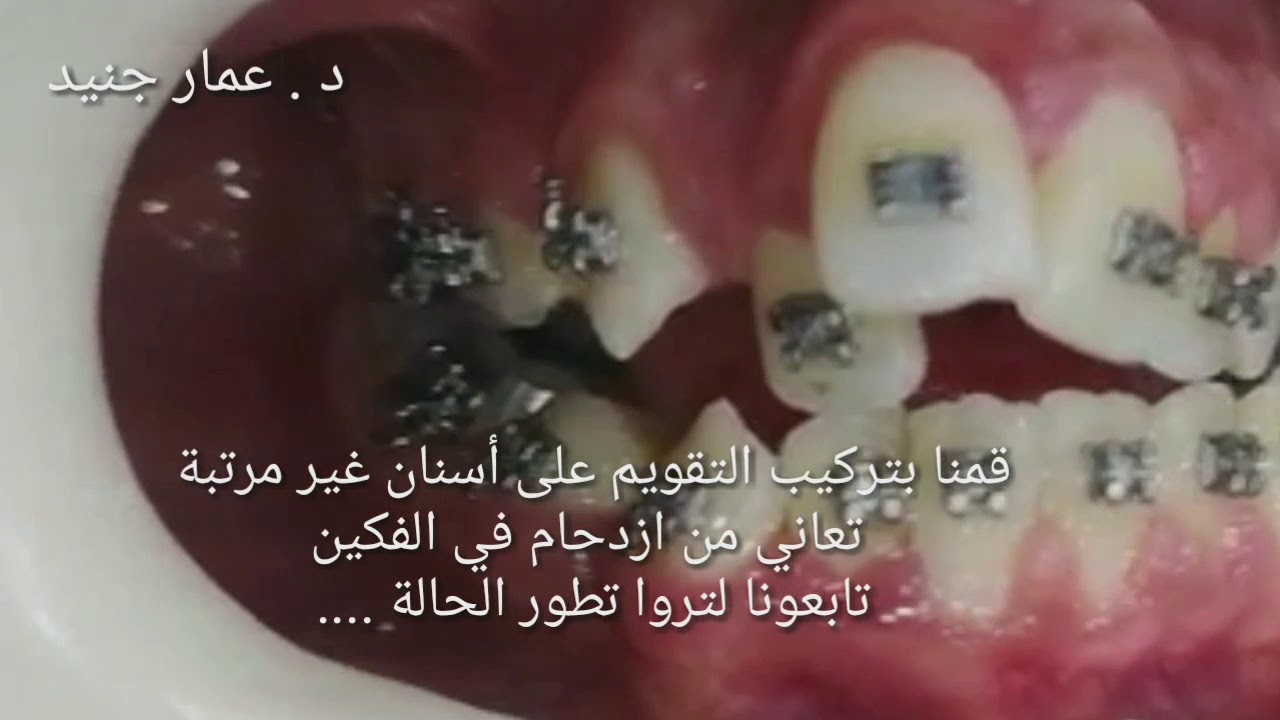 شكل بعد خمس جلسات تقويم