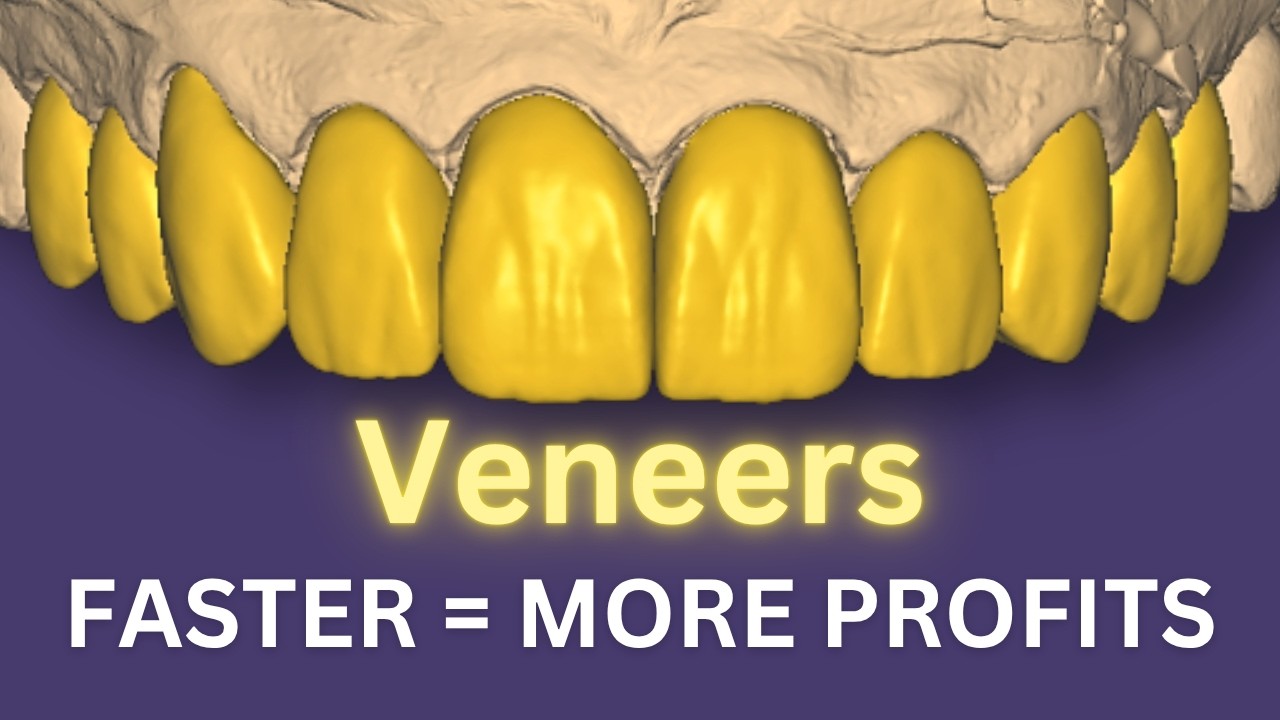 Design Expensive VENEERS in 2025 EXOCAD 3.2