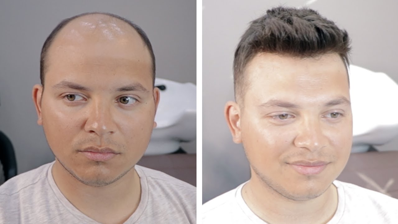 PROTEZ SAÇ NASIL YAPILIR - Hair Replacement