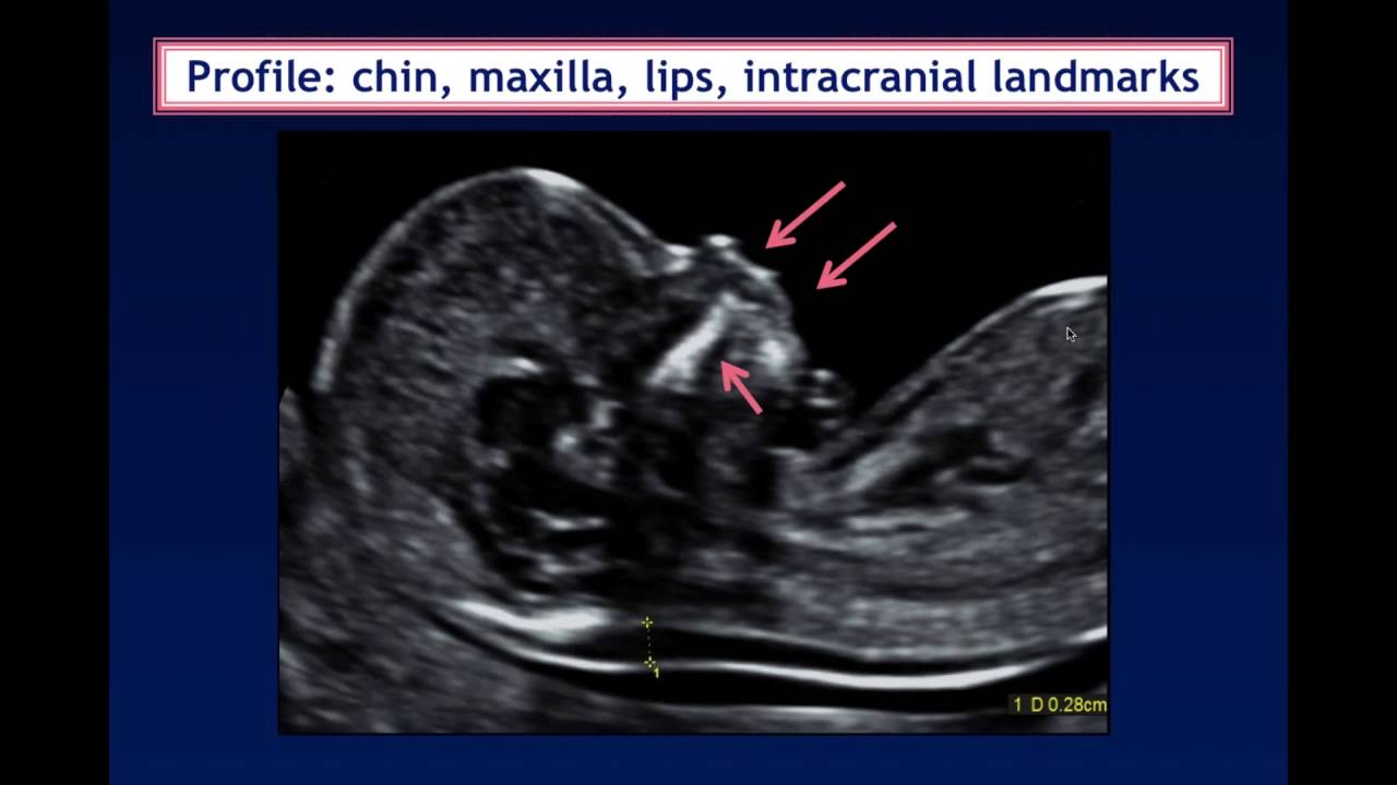 AIUM Webinar: Systematic Evaluation of the 11-14 Week Fetus, Touching on ISUOG Guidelines