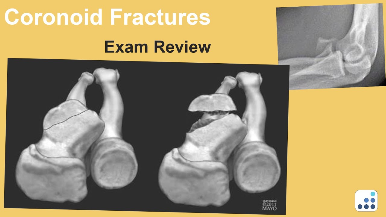 Coronoid Fractures Exam Review - Mark S. Cohen, MD