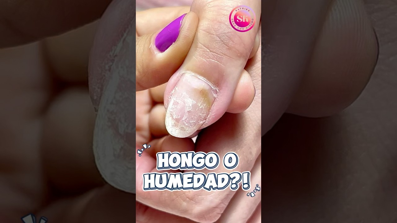 ¿Manchas en las uñas? Cómo saber si es hongo o solo humedad 🍄💅