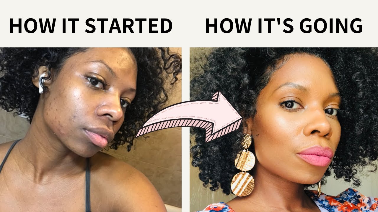 How to Treat Hormonal Acne on Black Women - Part 1