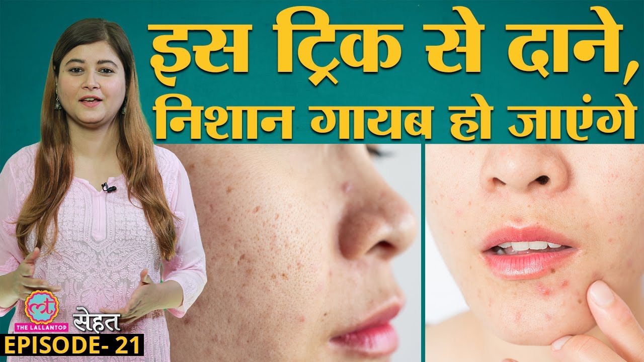 Acne, Scars, Pimples से कैसे छुटकारा पाएं खुद Doctors से सुने | Sehat Ep 21