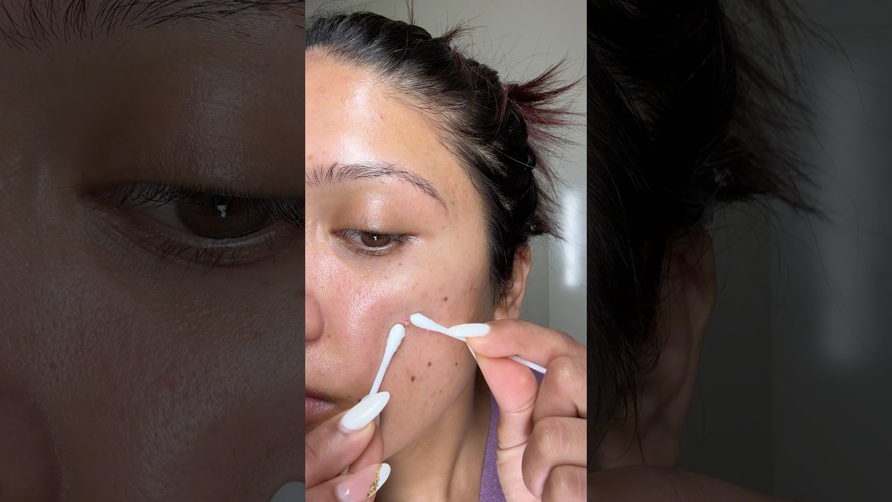 Let&rsquo;s peel this mega pimple patch and do some extraction #acne #pimplepatch #acnepatch #acneprone