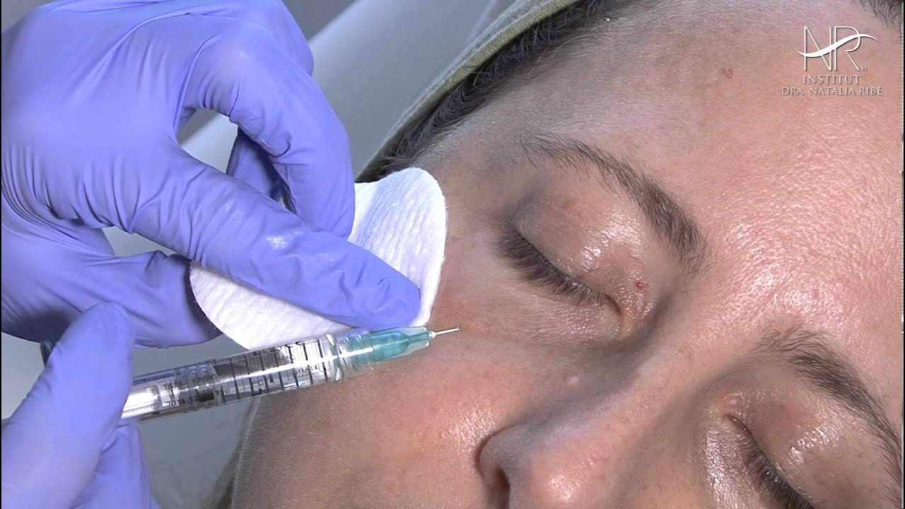 Rejuvenecimiento de las ojeras - Técnica Atenea (Mujer)