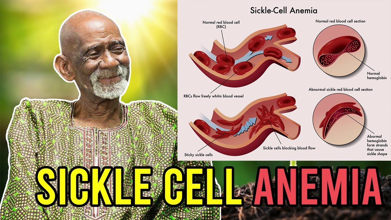 Natural Remedy For Sickle Cell Anemia By Dr Sebi