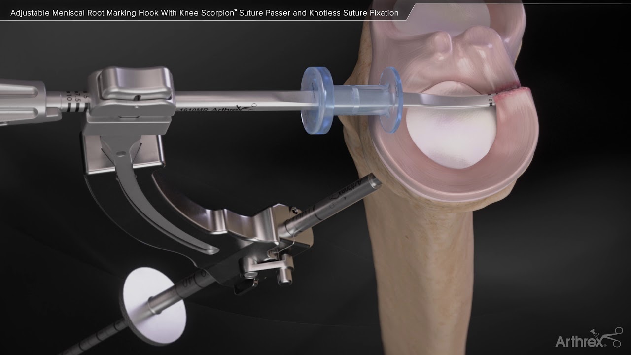 Adjustable Meniscal Root Marking Hook With Knee Scorpion™ Suture Passer and Knotless Suture Fixation