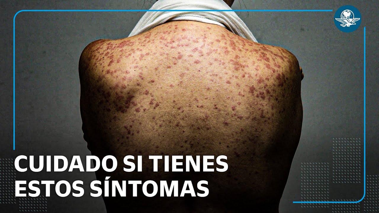 Aumentan contagios de sarampión en México: ¿cuáles son los síntomas?