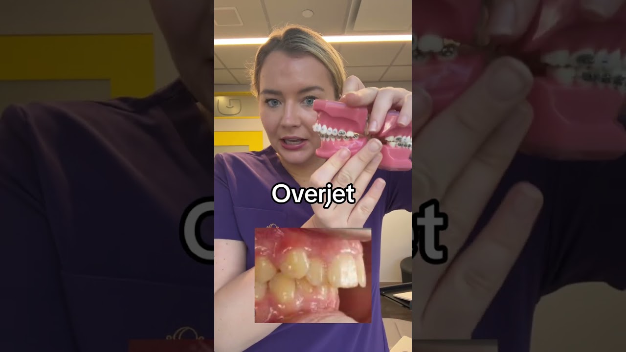 Overjet vs overbite #braces #overbite #overjet