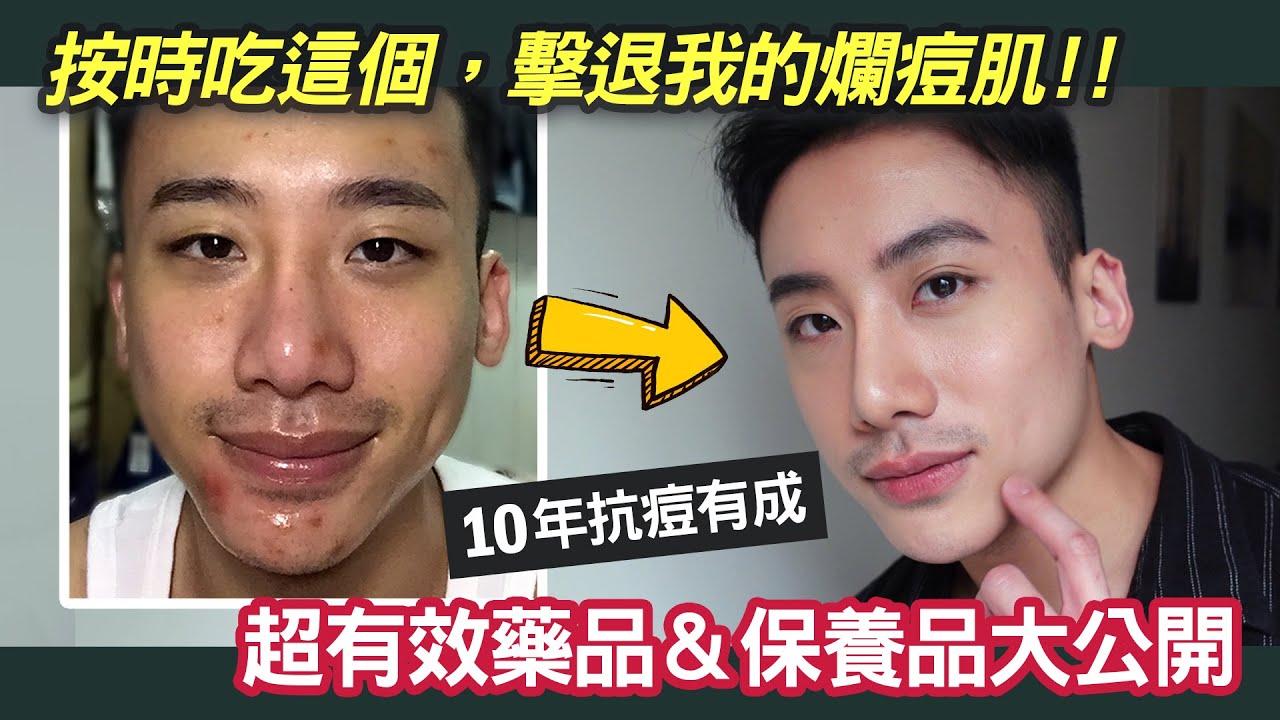 油痘肌吃這個就對了！超有效抗痘、去粉刺藥物＆保養品大公開 ft. Dr.May