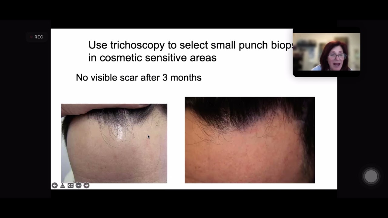 Frontal Fibrosing Alopecia