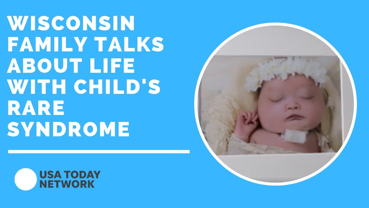 Wisconsin family talks about life with child's rare syndrome
