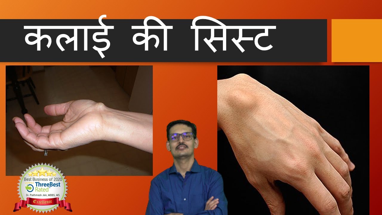 कलाई-की-सिस्ट Wrist Ganglion Cyst Hindi.