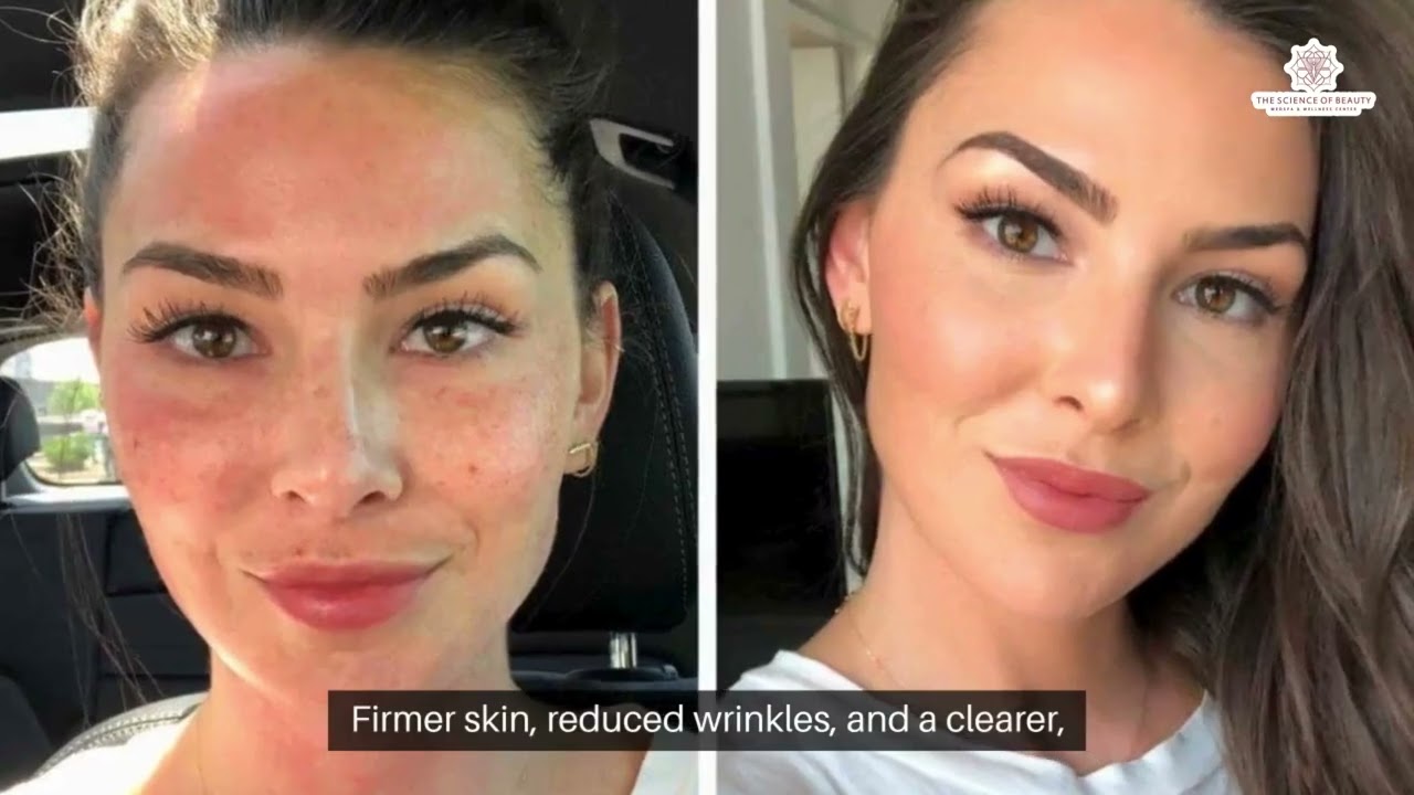 Morpheus8 Results in Dallas, TX | Skin Rejuvenation & Maintenance Tips