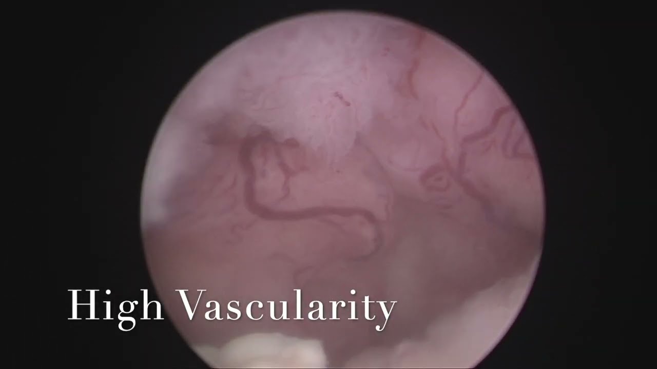 Diagnostic Hysteroscopy- Endometrial Cancer