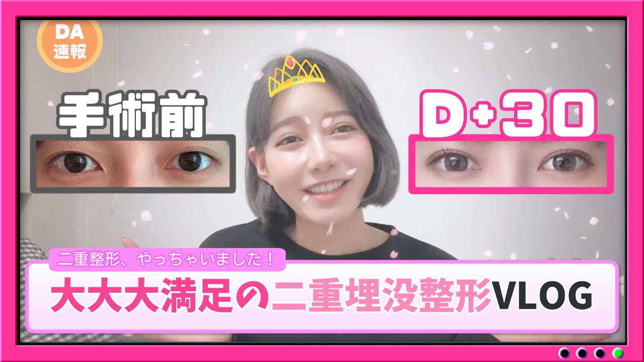 [二重埋没][VLOG]二重整形して可愛くなっちゃった！2ヵ月間のダウンタイムまとめ