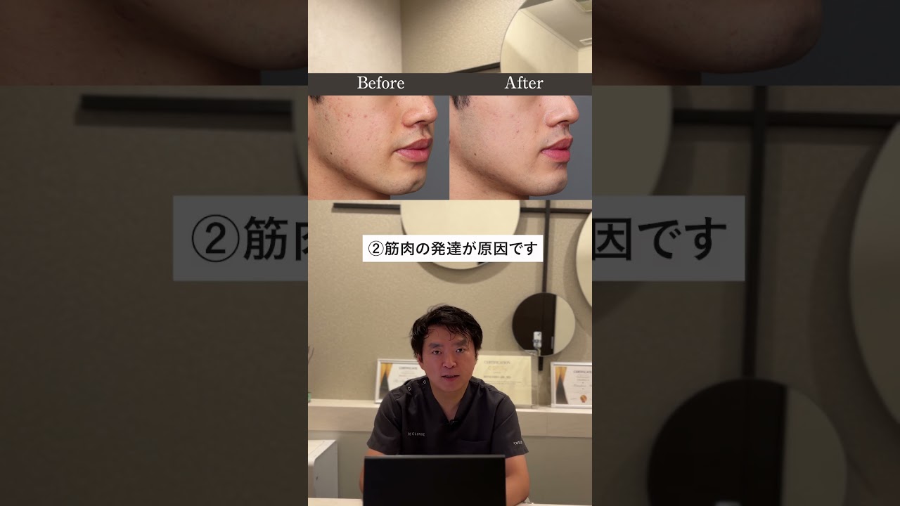 割れ顎の原因と治し方をわかりやすく解説！