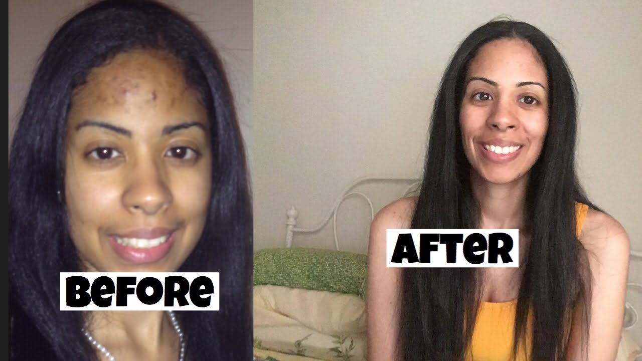 Is witch hazel good for your skin?! I tried witch hazel and this happened.