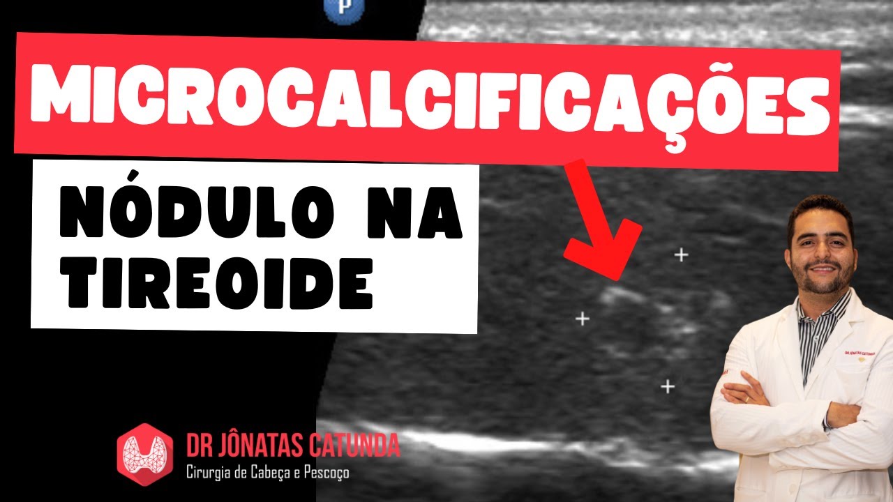 Microcalcificação em nódulo na tireoide - preocupante? Maligno?