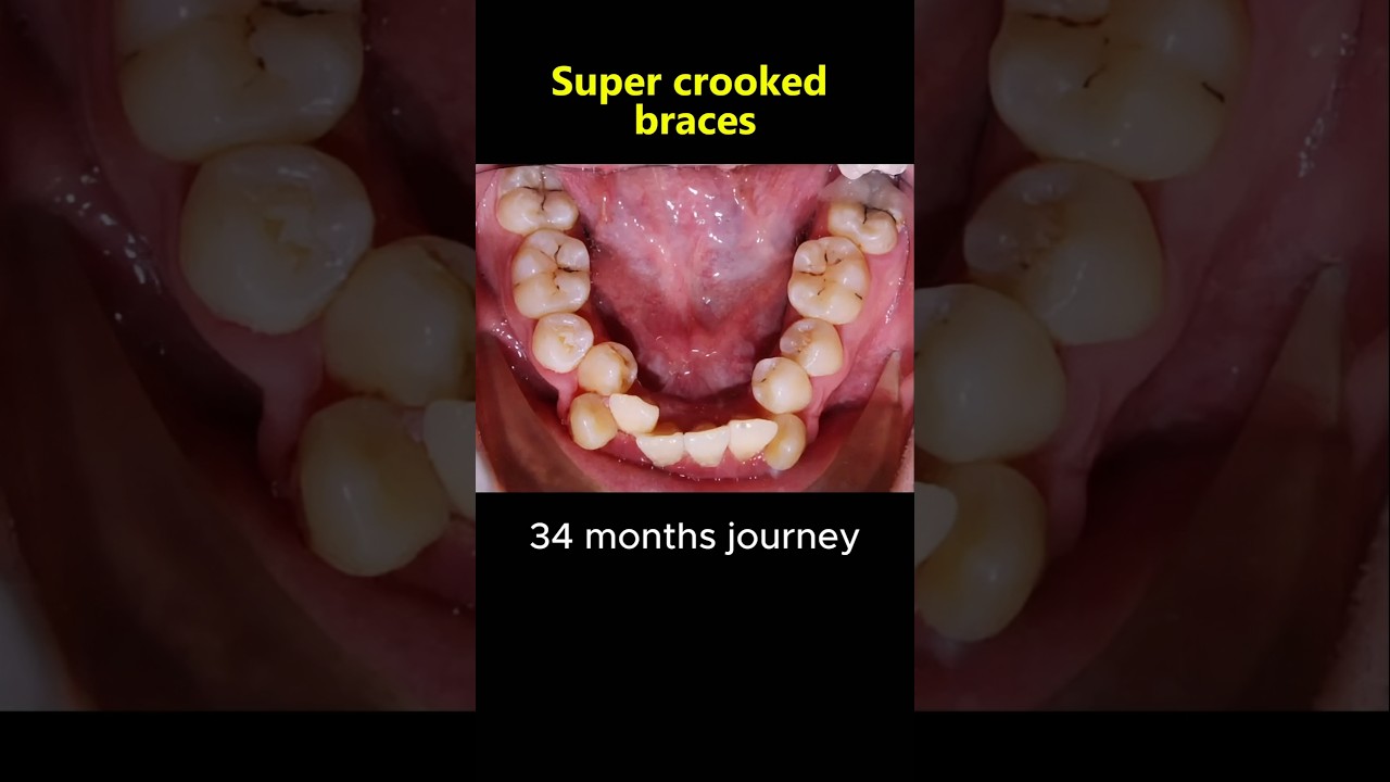 Braces journey 34 months. Fix super crooked teeth #braces #dentist #orthodontist