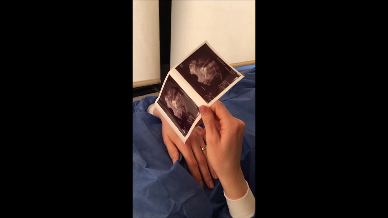 Embryo Transfer