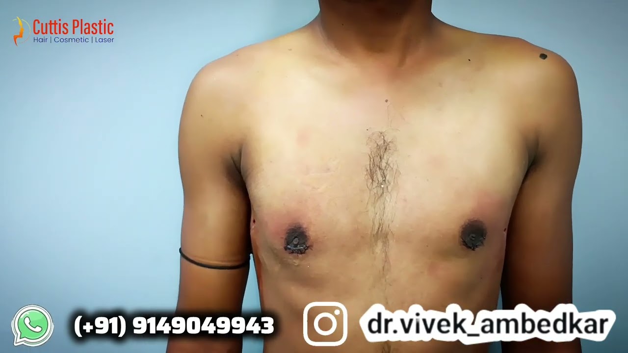 Gynaecomastia Surgery Result | Male Chest Fat Removal | Dr Vivek Ambedkar MCh Plastic Surgeon