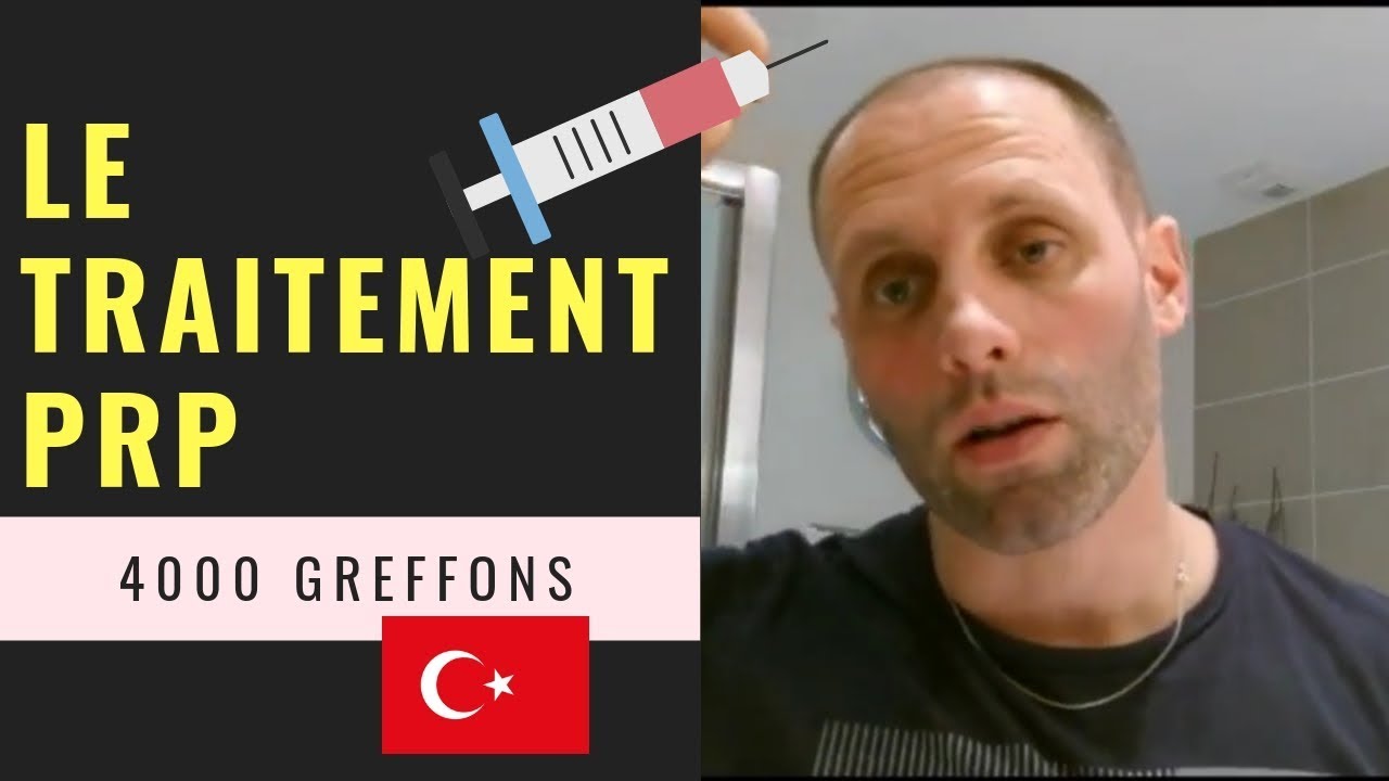 Greffe de cheveux FUE en Turquie [Vidéo 8] - Le traitement PRP (+17 jours)- 4000 Greffons