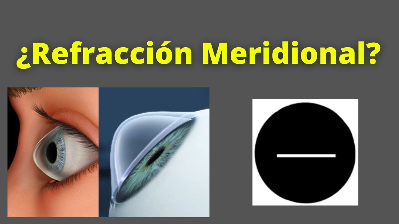 Refracción en Queratocono. 3 recomendaciones.(Parte II)