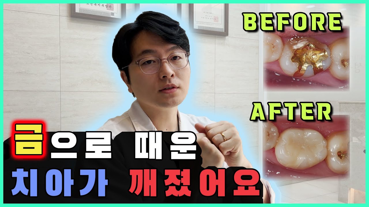 지르코니아 온레이, 어금니 파절의 가장 보존적인 치료방법