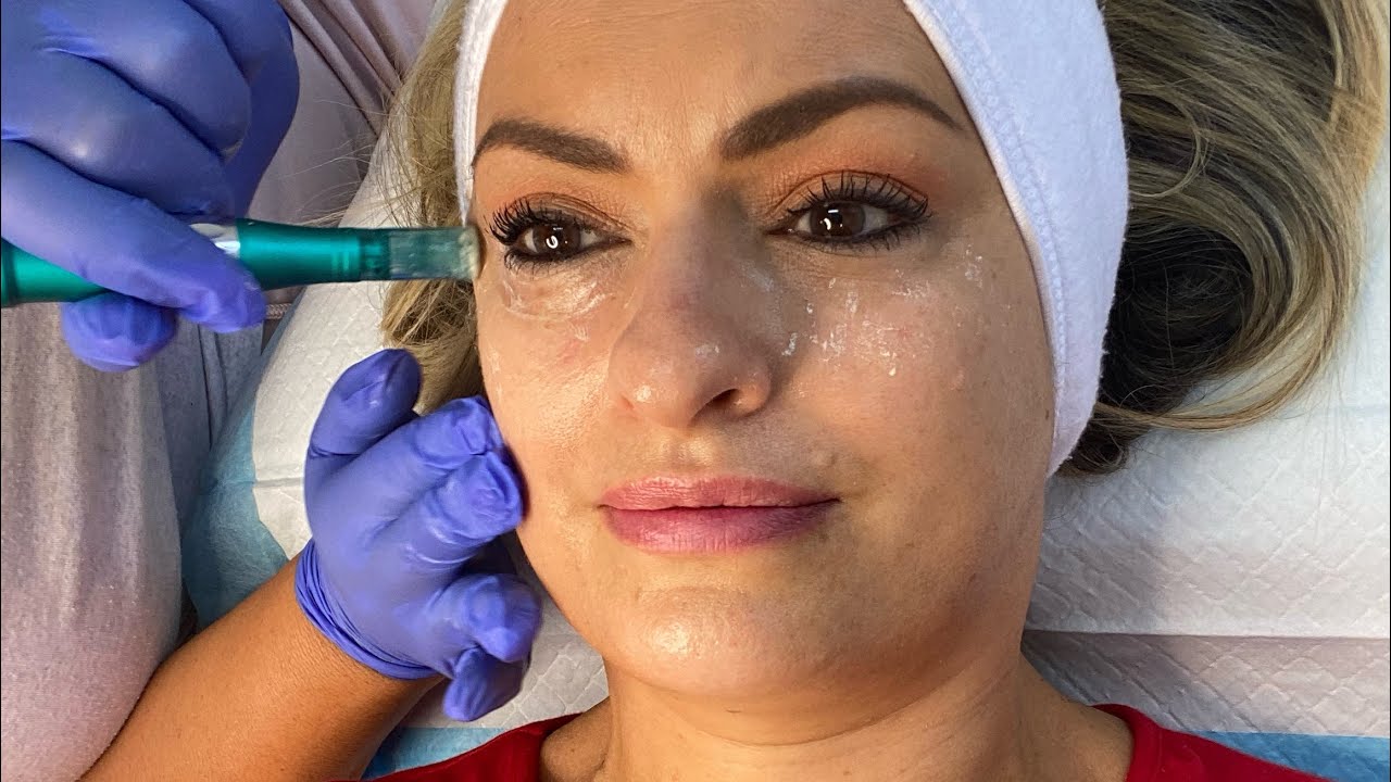 #HAFiller #beautytreatment #noninvasive #noninvasivetreatment #perthblogger #perthinfluencer