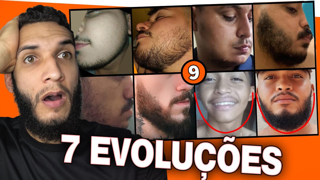 7 EVOLUÇÕES COM MINOXIDIL #9