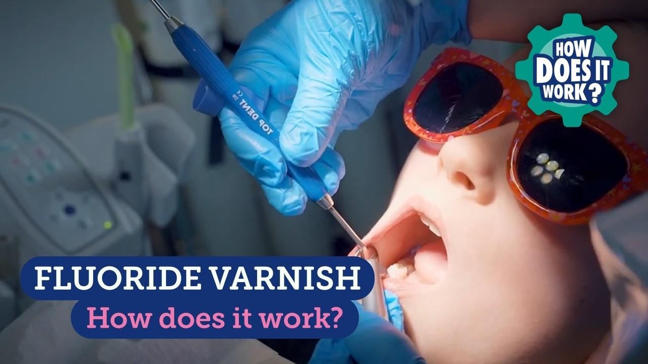 Fluoride Varnish