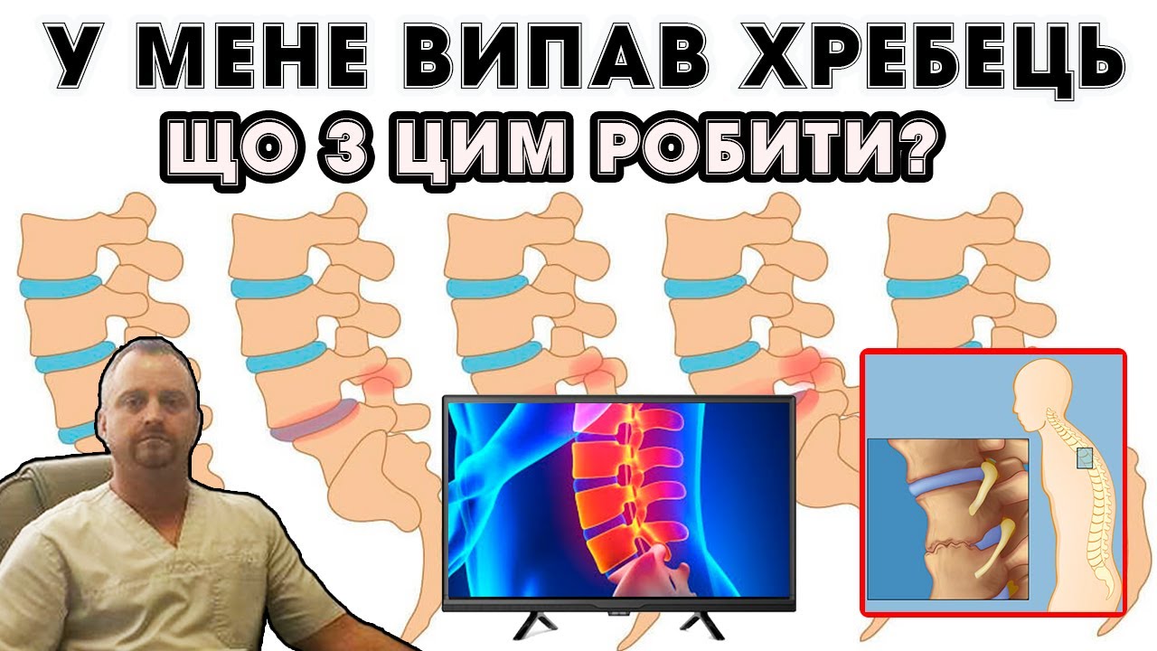 Зміщення хребців: що це і як відновлювати здоров'я. Лістез - зміщення хребців - симптоми, лікування
